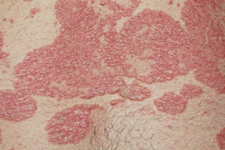 Vùng kín bị ngứa và nổi hạt: Nguyên nhân và cách điều trị