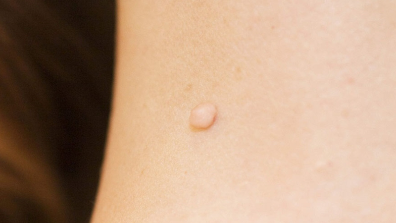 Đốt mụn thịt giá bao nhiêu? Cách chăm sóc sau khi đốt mụn thịt