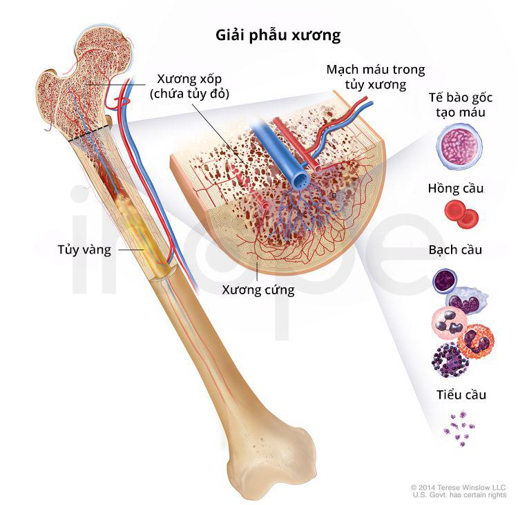 Dấu hiệu của bệnh bạch cầu dòng tủy cấp tính (AML)