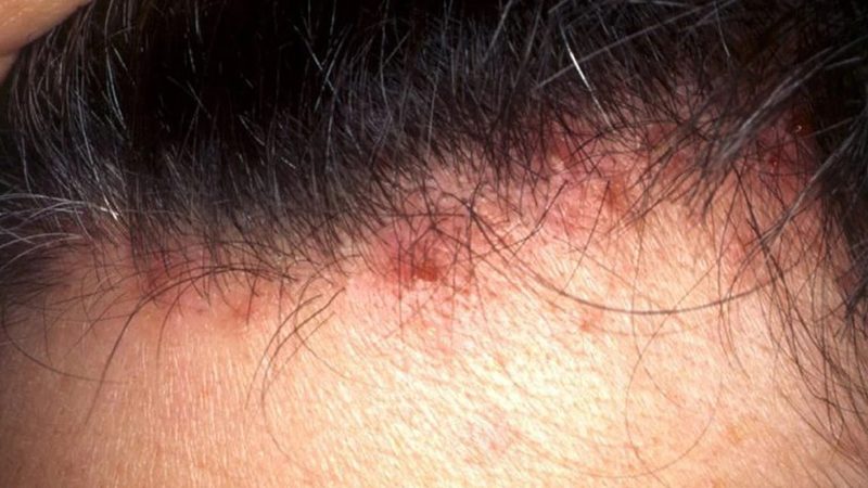 Mụn mọc ở trán gần chân tóc là do đâu? Cách khắc phục