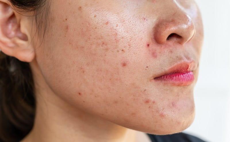 Các bước skincare cho da dầu mụn nhạy cảm đơn giản mà hiệu quả