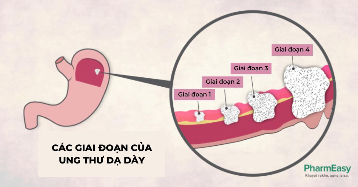 Các giai đoạn ung thư dạ dày