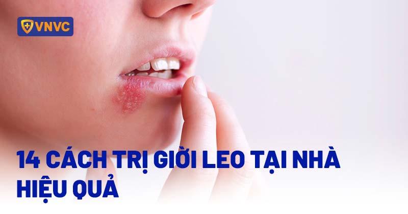 14 cách trị giời leo tại nhà hiệu quả cấp tốc, dễ áp dụng