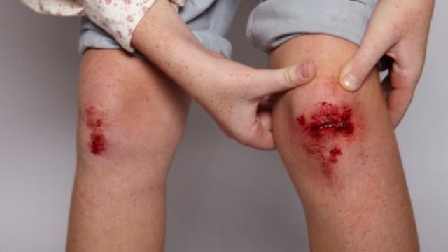 Mách bạn một số cách chăm sóc vết thương té xe nhanh lành