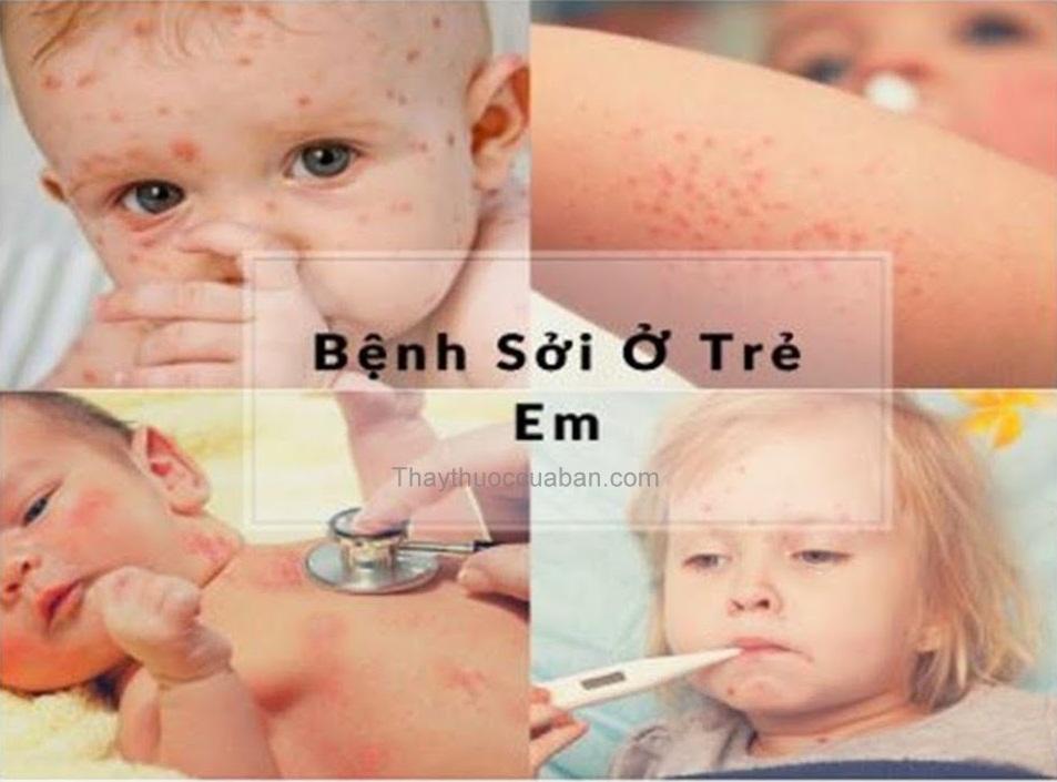 Bệnh sởi chạy hậu, nguyên nhân và cách điều trị