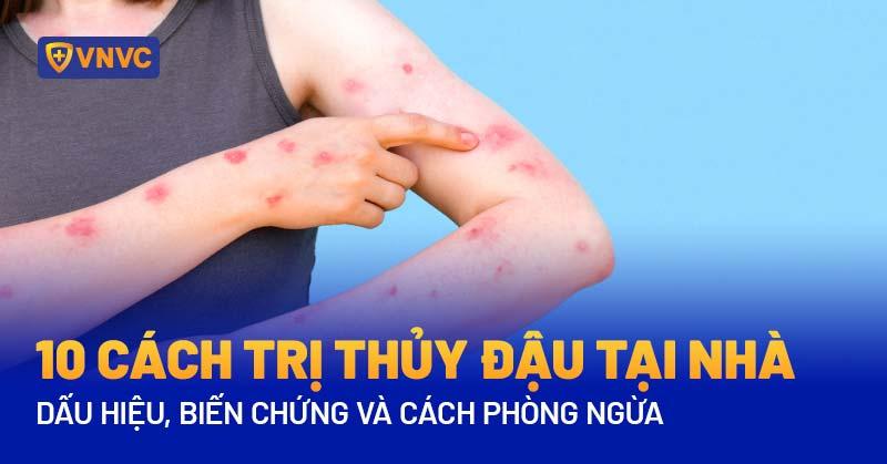 cách trị thủy đậu tại nhà