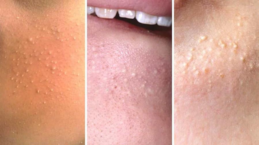 Mụn đầu trắng - Nguyên nhân và cách điều trị triệt để