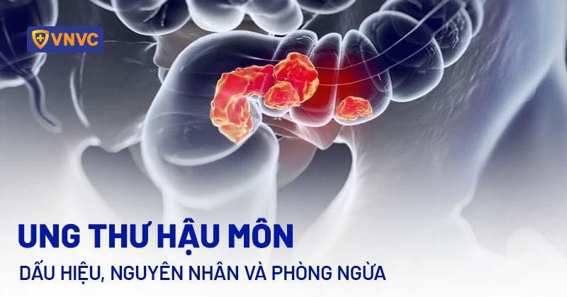 Ung thư hậu môn: Dấu hiệu, nguyên nhân và phòng ngừa