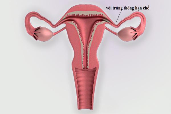 Vòi trứng thông hạn chế: Nguyên nhân, chẩn đoán và cách điều trị