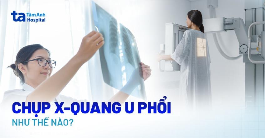 Chụp x-quang phổi giúp phát hiện bệnh gì, bao nhiêu tiền?