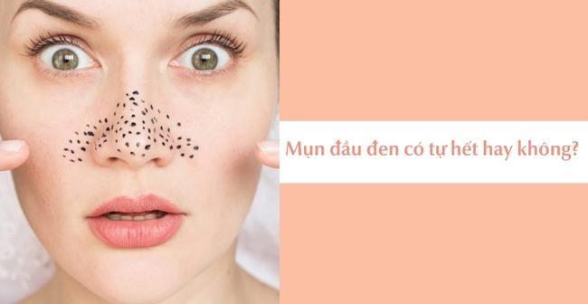 Không nặn mụn có tự hết không? Có nên chờ mụn tự khỏi?