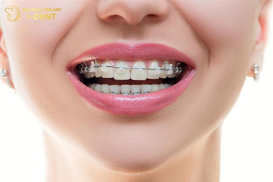 Niềng Răng Mắc Cài Pha Lê Là Gì?