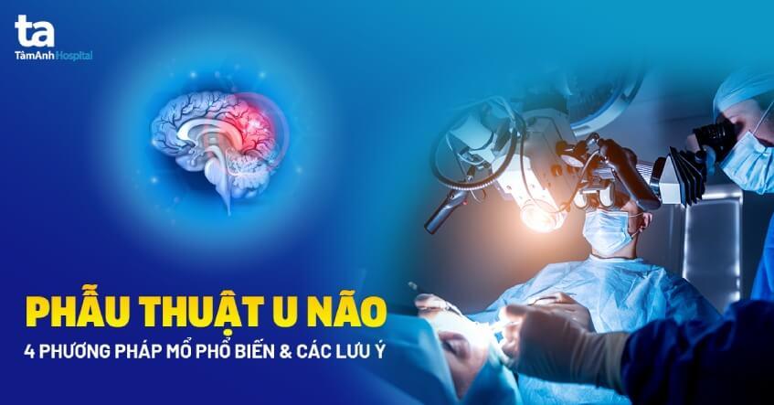 U màng não có nên mổ không? Chi phí và biến chứng sau phẫu thuật