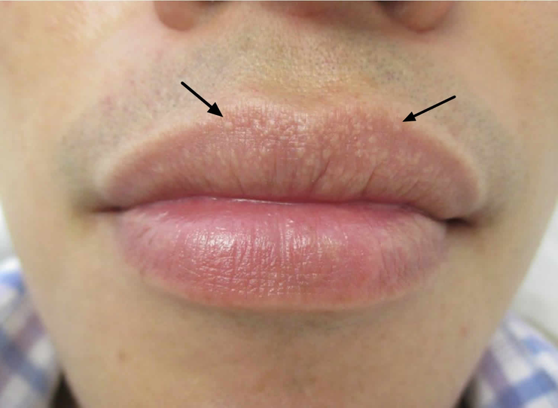 Nguyên nhân và cách chữa đốm trắng trên môi 1