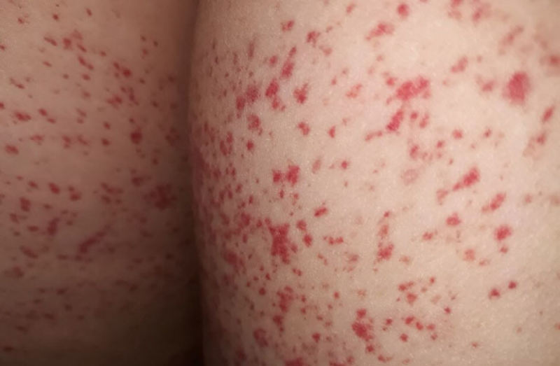 Nổi mẩn đỏ ở mông nhưng không ngứa là bị bệnh gì?