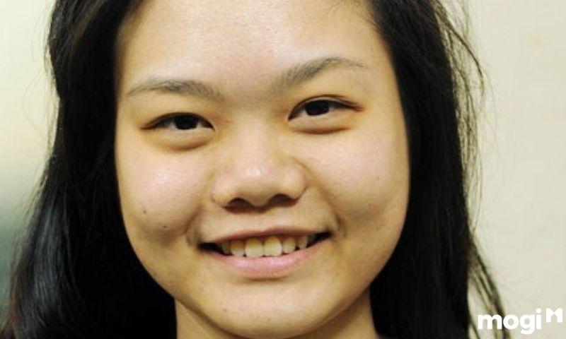 Mũi lân tốt hay xấu? Có nên phẩu thuật mũi lân không?