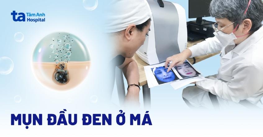 Mụn đầu đen ở má: Nguyên nhân, dấu hiệu và phòng ngừa