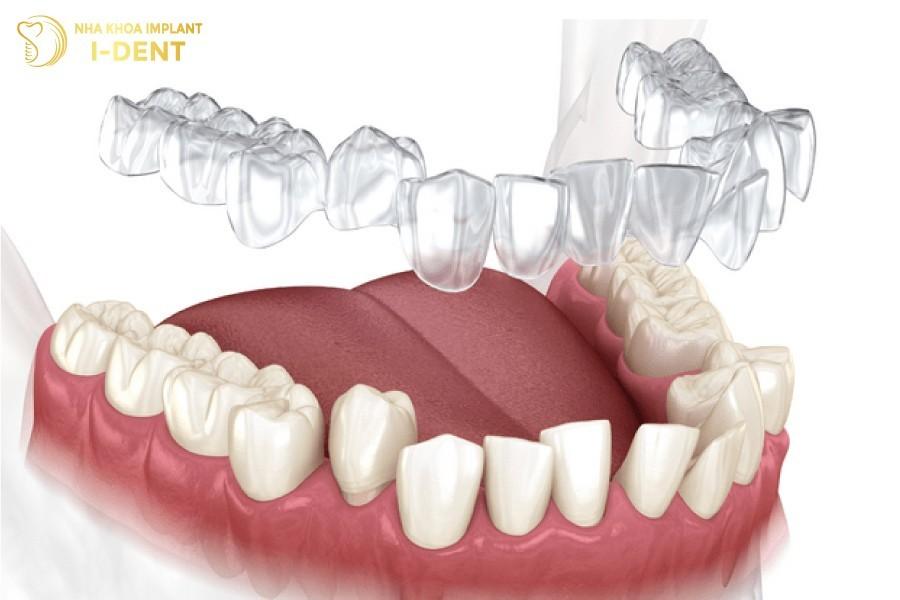 Niềng răng trong suốt giá bao nhiêu? Giá niềng răng trong suốt Invisalign tại TP.HCM