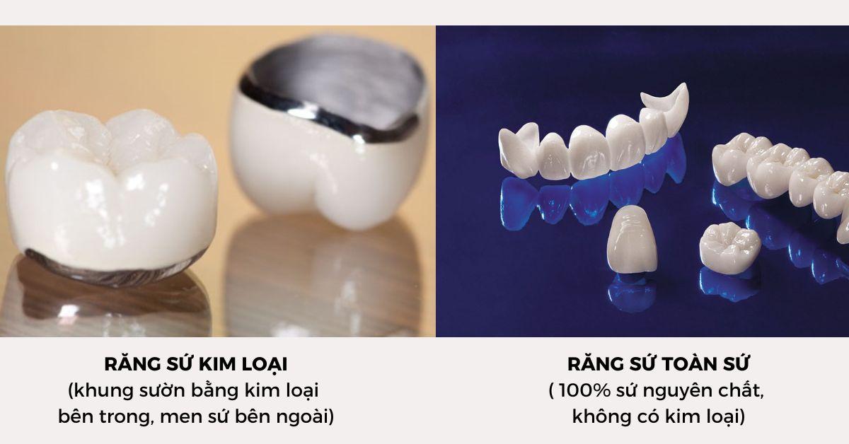 Răng sứ kim loại và răng sứ toàn sứ