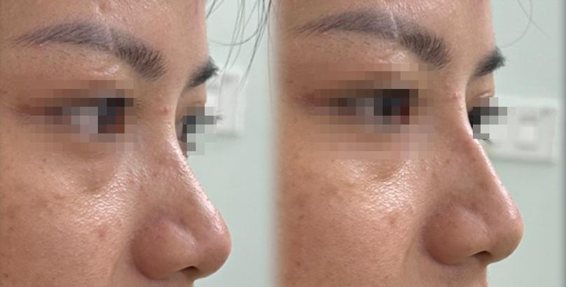 Nên nâng mũi bằng chỉ hay tiêm filler