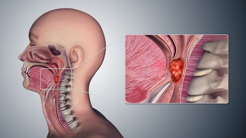 Ung thư vòm họng là gì? Gợi ý thực đơn cho người ung thư vòm họng 1