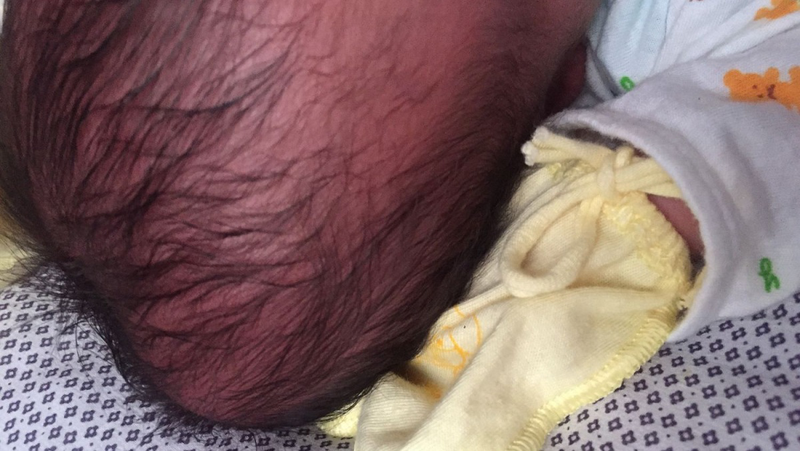 Giải đáp thắc mắc: Bướu huyết thanh ở trẻ sơ sinh bao lâu thì hết?