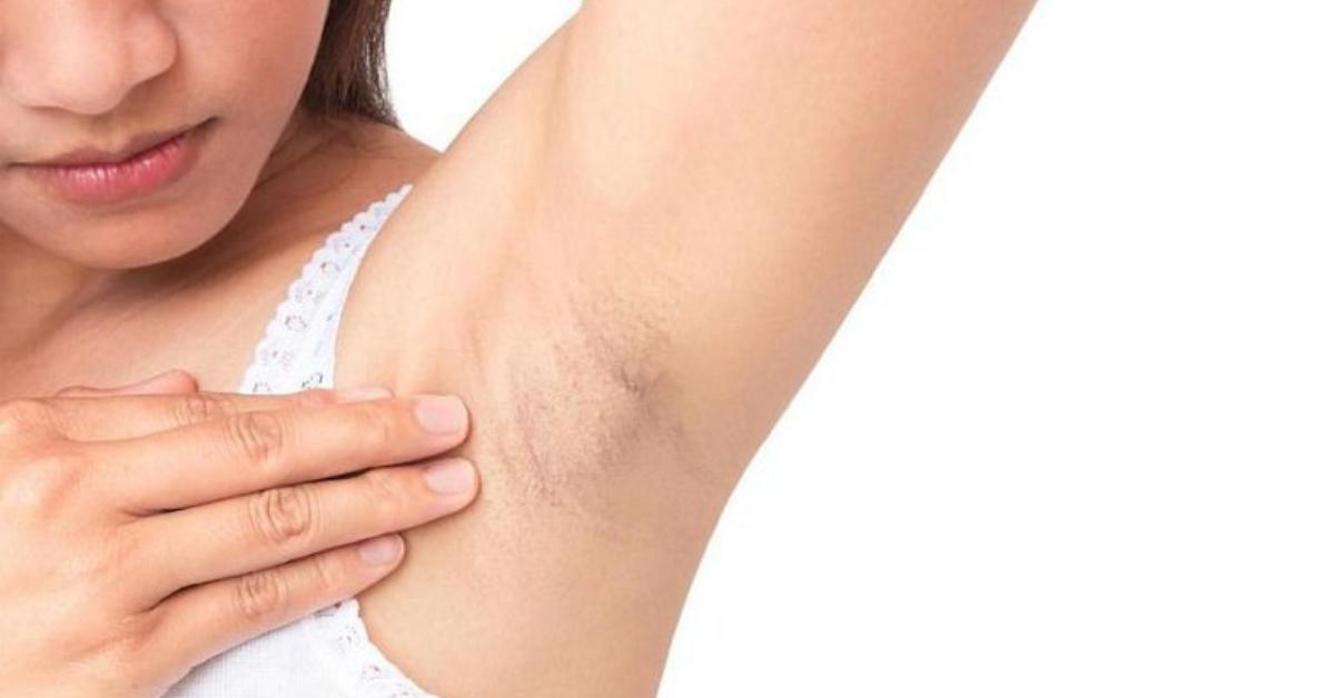 Nguyên nhân nách bị nổi mụn và các loại mụn ở nách