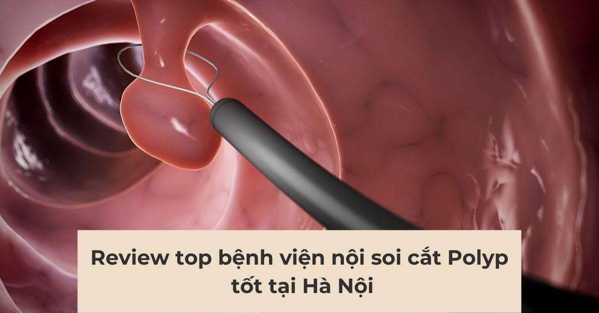 Nội soi cắt polyp ở đâu tốt tại Hà Nội: Review 7 bệnh viện top đầu