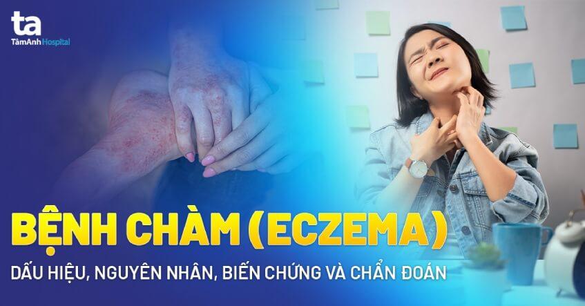 Chàm da tay: Dấu hiệu, nguyên nhân và cách chữa trị