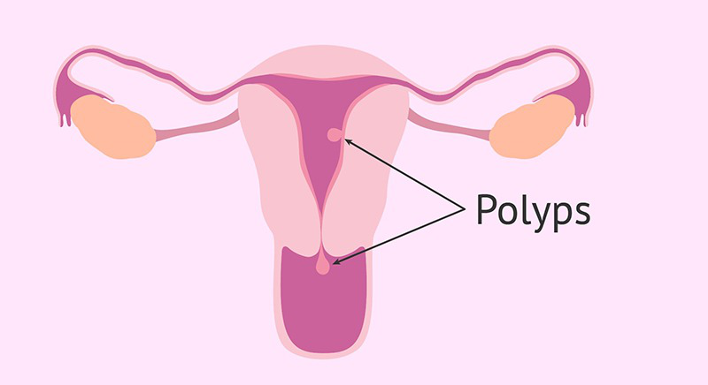 chi-phi-cat-polyp-tu-cung-la-bao-nhieu 1.jpg