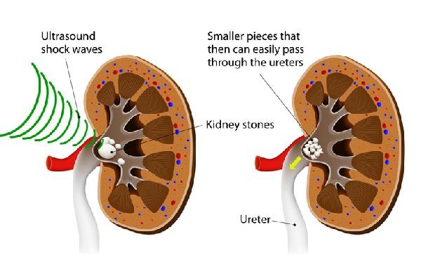 Sỏi thận: Nguyên nhân, dấu hiệu và cách điều trị