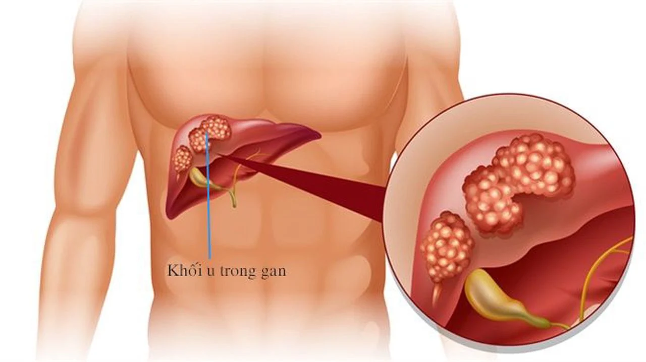 Ung thư là gì? Nguyên nhân, triệu chứng, phương pháp phòng ngừa