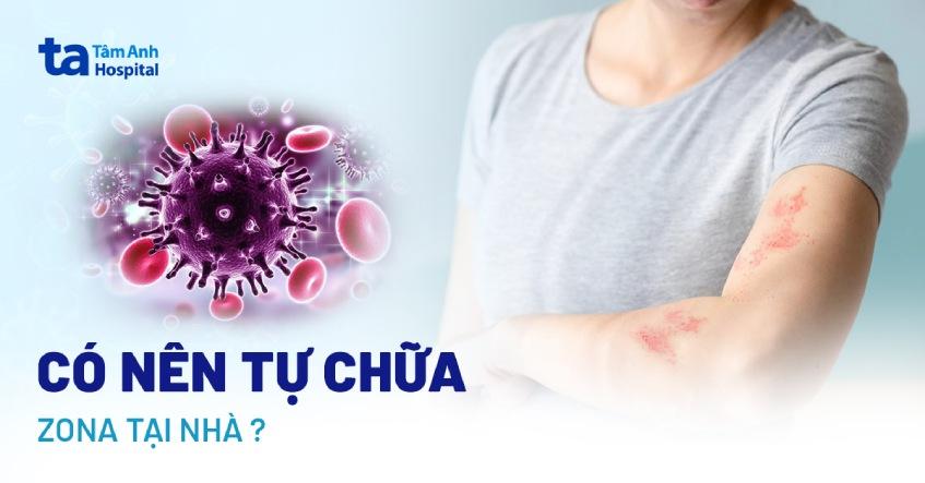 Trị giời leo bằng cây lá thuốc Nam