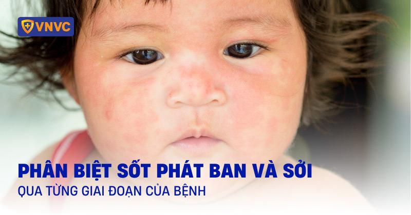 phân biệt sốt phát ban và sởi