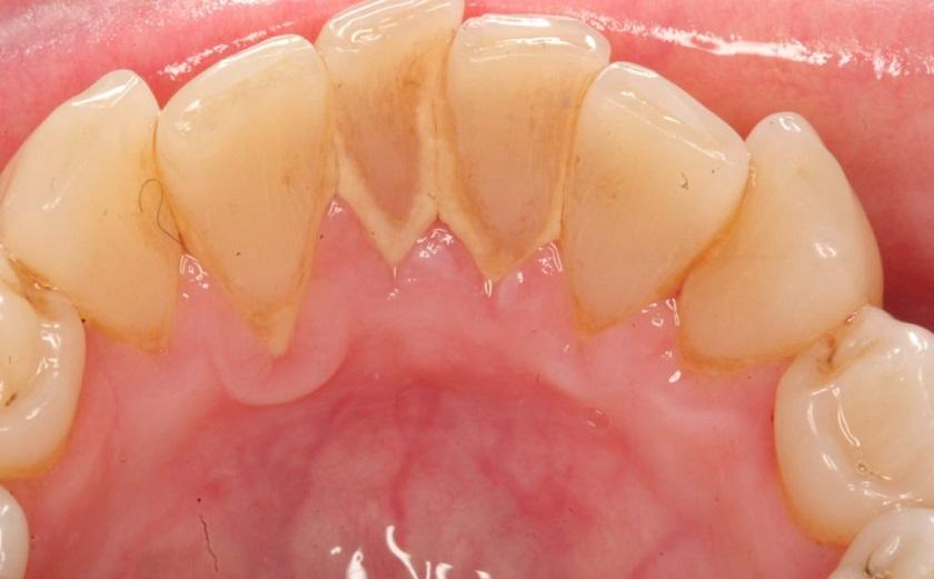 Khái niệm bựa răng là gì? Cách điều trị bựa răng hiệu quả?