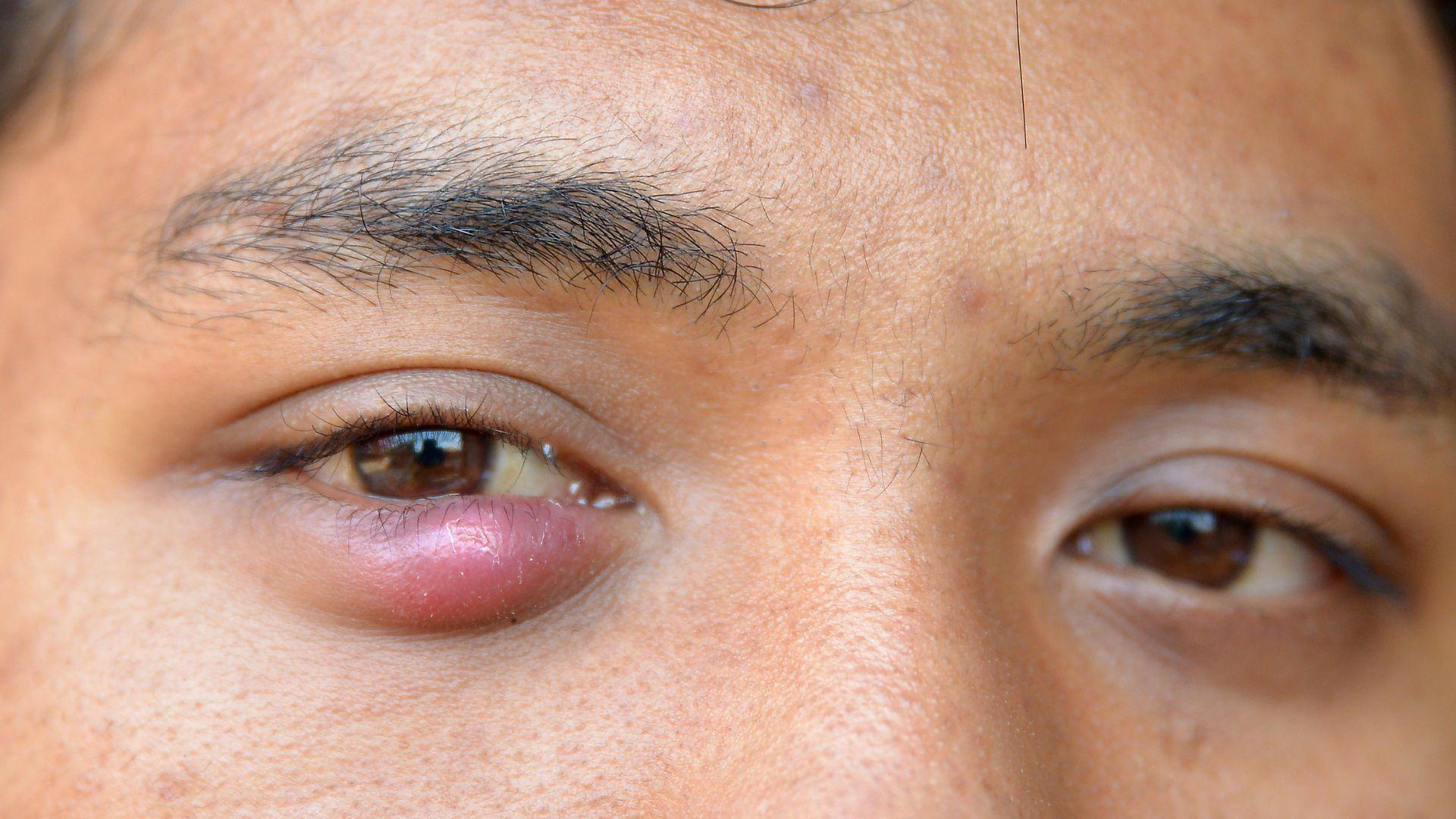 Chích lẹo mắt bao lâu thì khỏi? 2