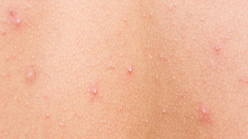 Hình ảnh các loại mụn khác nhau và cách điều trị hiệu quả 1