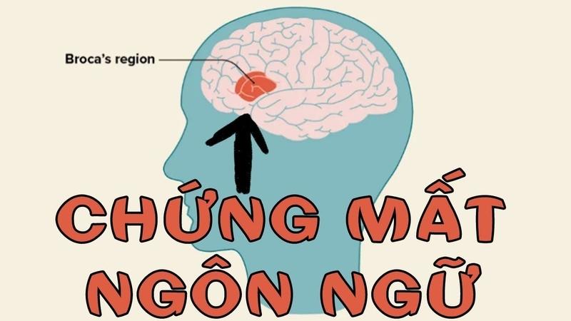 that-ngon-la-gi-nguyen-nhan-dan-den-that-ngon-va-phuong-phap-dieu-tri 1.jpg
