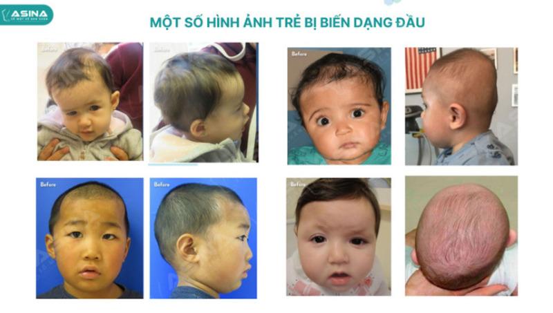 chữa bẹp đầu cho trẻ 3 tháng tuổi