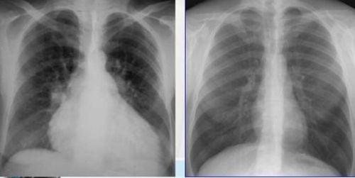 Hình ảnh bóng tim to trên X quang