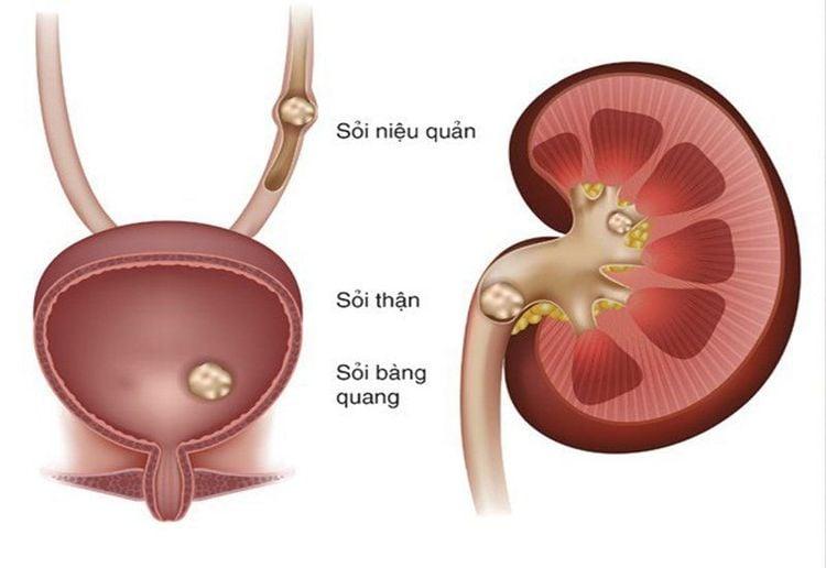Bệnh dễ gây sỏi ở trong các nang ở 1 hoặc cả 2 bên thận