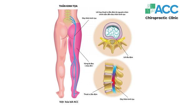 thoát vị đĩa đệm có thể là nguyên nhân gây đau thần kinh tọa