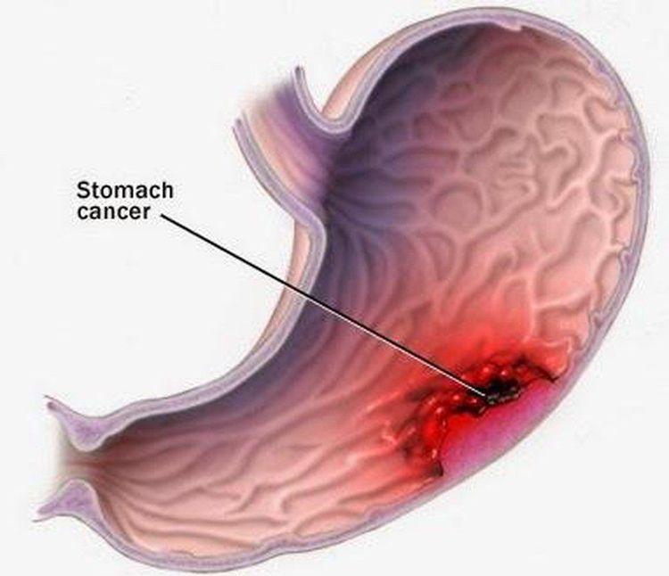 Rối loạn đại tiện là triệu chứng của bệnh xuất huyết dạ dày