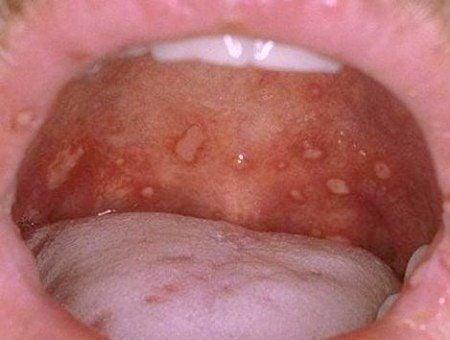 Hình ảnh bệnh tay chân miệng với các mụn nước trong khoang miệng