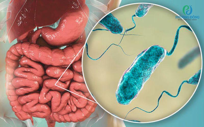 Bệnh thổ tả ở trẻ em là bệnh nhiễm trùng đường ruột do vi trùng gây ra