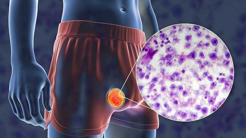 Ung thư tinh hoàn: Dấu hiệu, triệu chứng biểu hiện là gì?