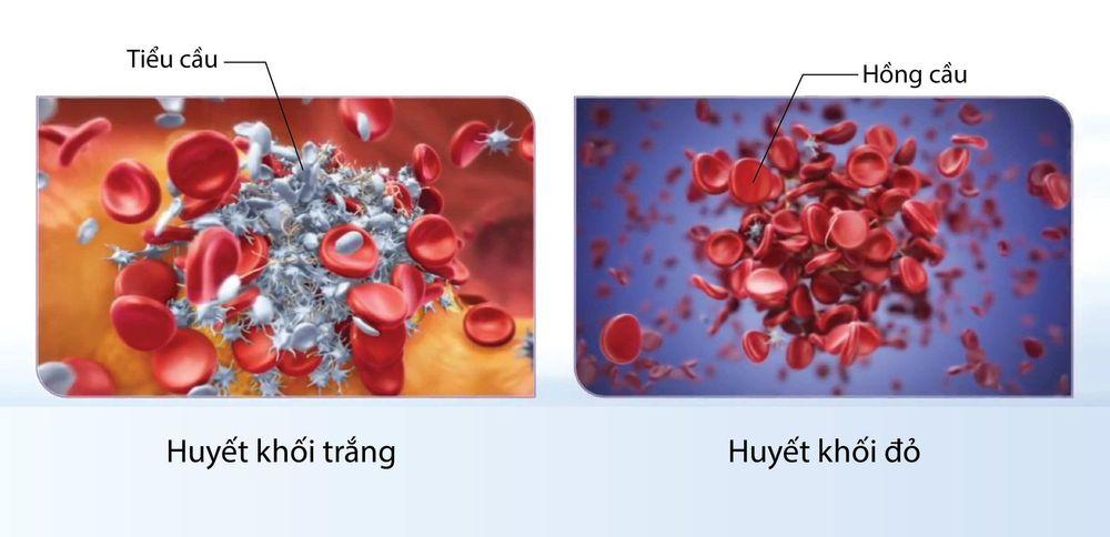 Xét về cấu trúc, huyết khối thường có hai loại là huyết khối trắng và đỏ