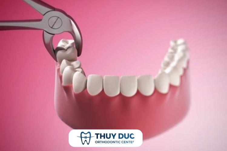 Tại sao nên nhổ răng khôn càng sớm càng tốt? 1