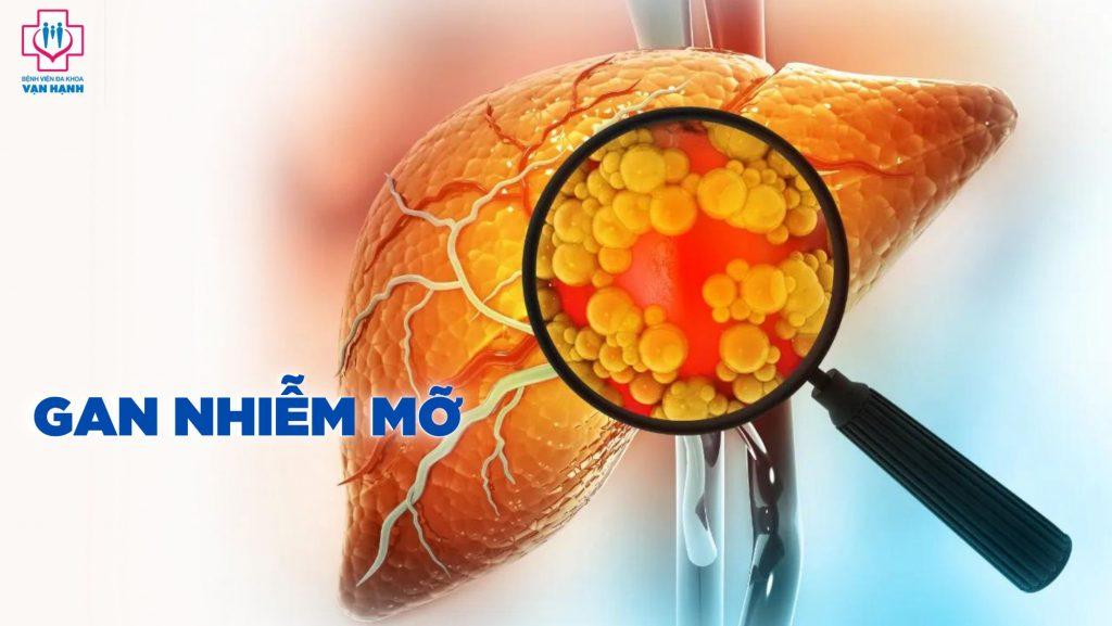 gan nhiễm mỡ triệu chứng và điều trị