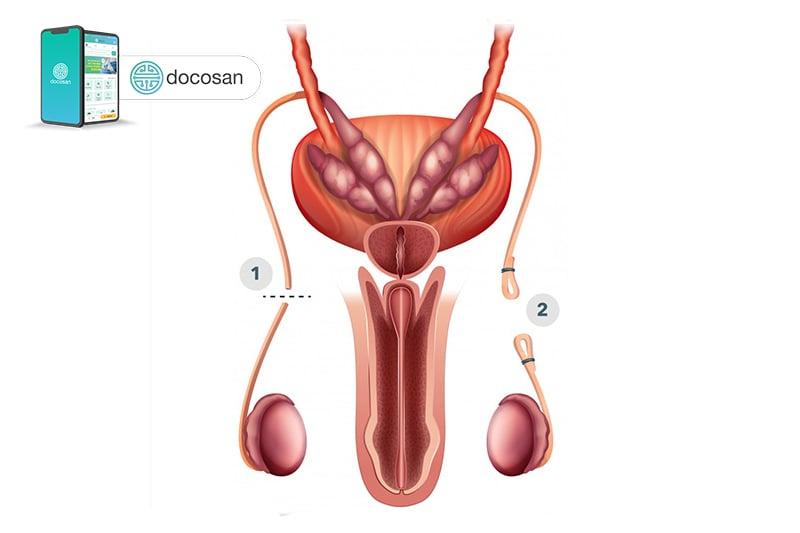 thắt ống dẫn tinh